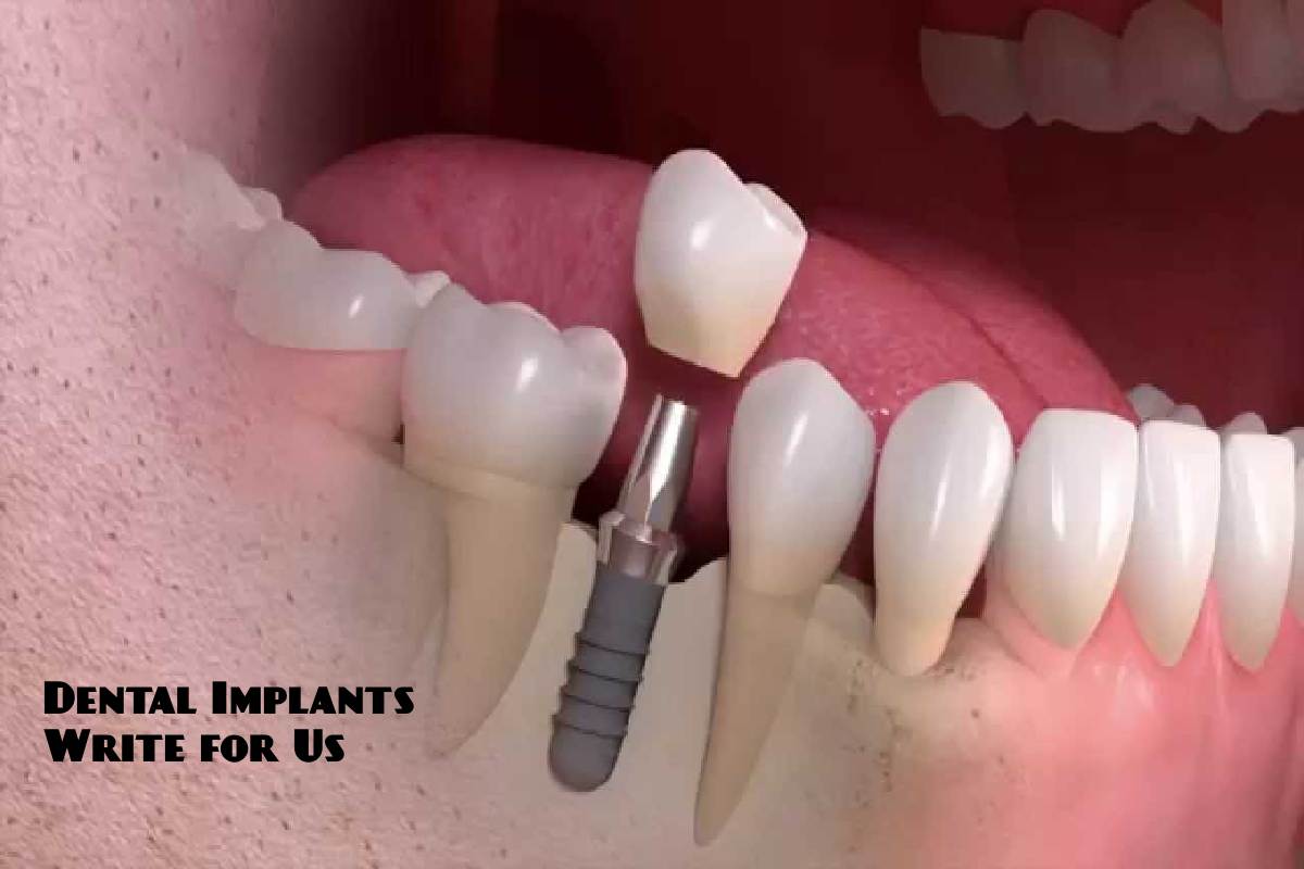 Dental Implants Write for Us